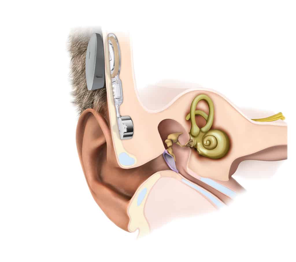 Bone Anchored hearing device
